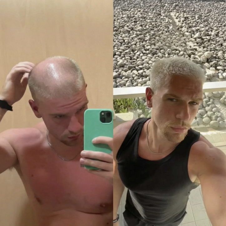 Johan — före och efter
